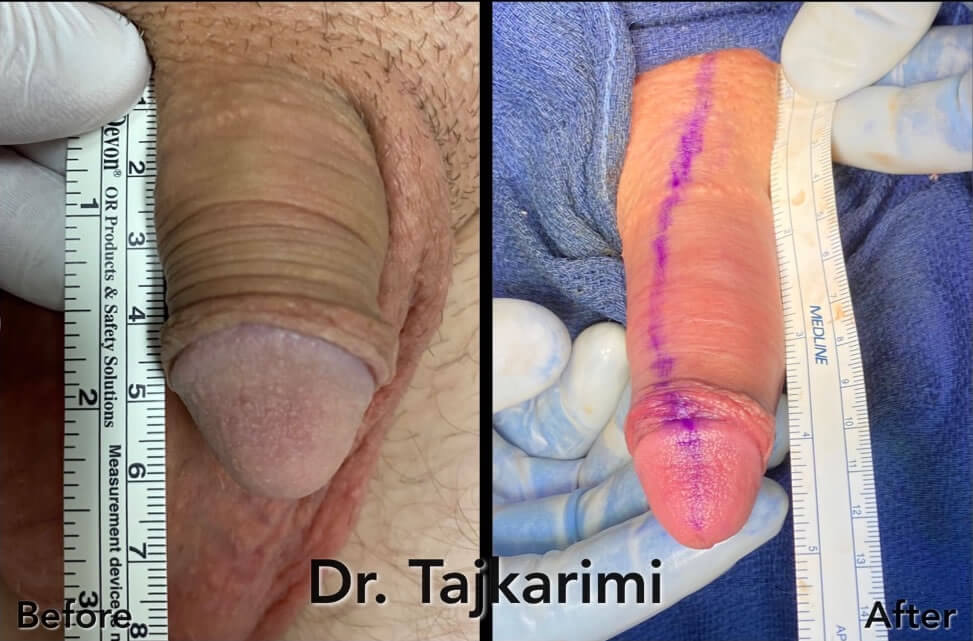 bryan gaceta recommends penile implant porn pic