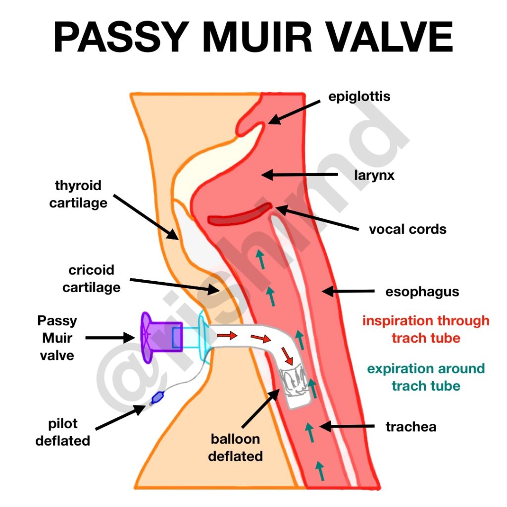 ann g hartman recommends pmv tube pic