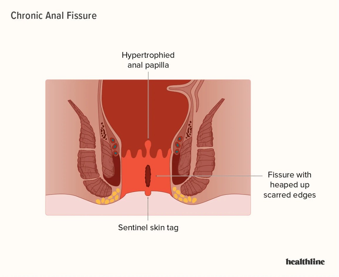 azhani azizi recommends Anal Acident