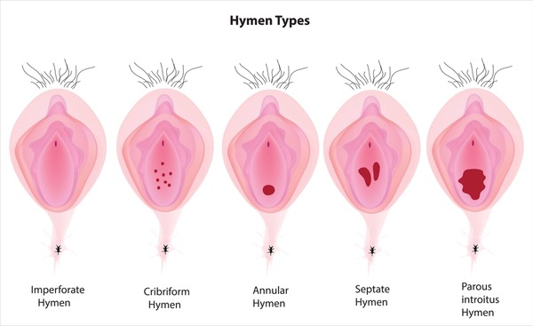 defloration of the hymen