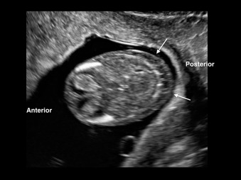 Legrand Wolf Ultrasound first film