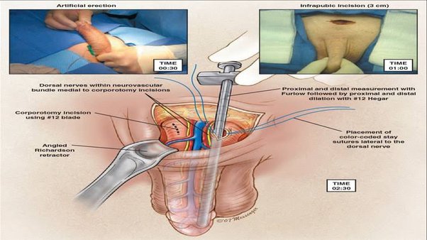 asha maloo add old man penile implant videos porn photo