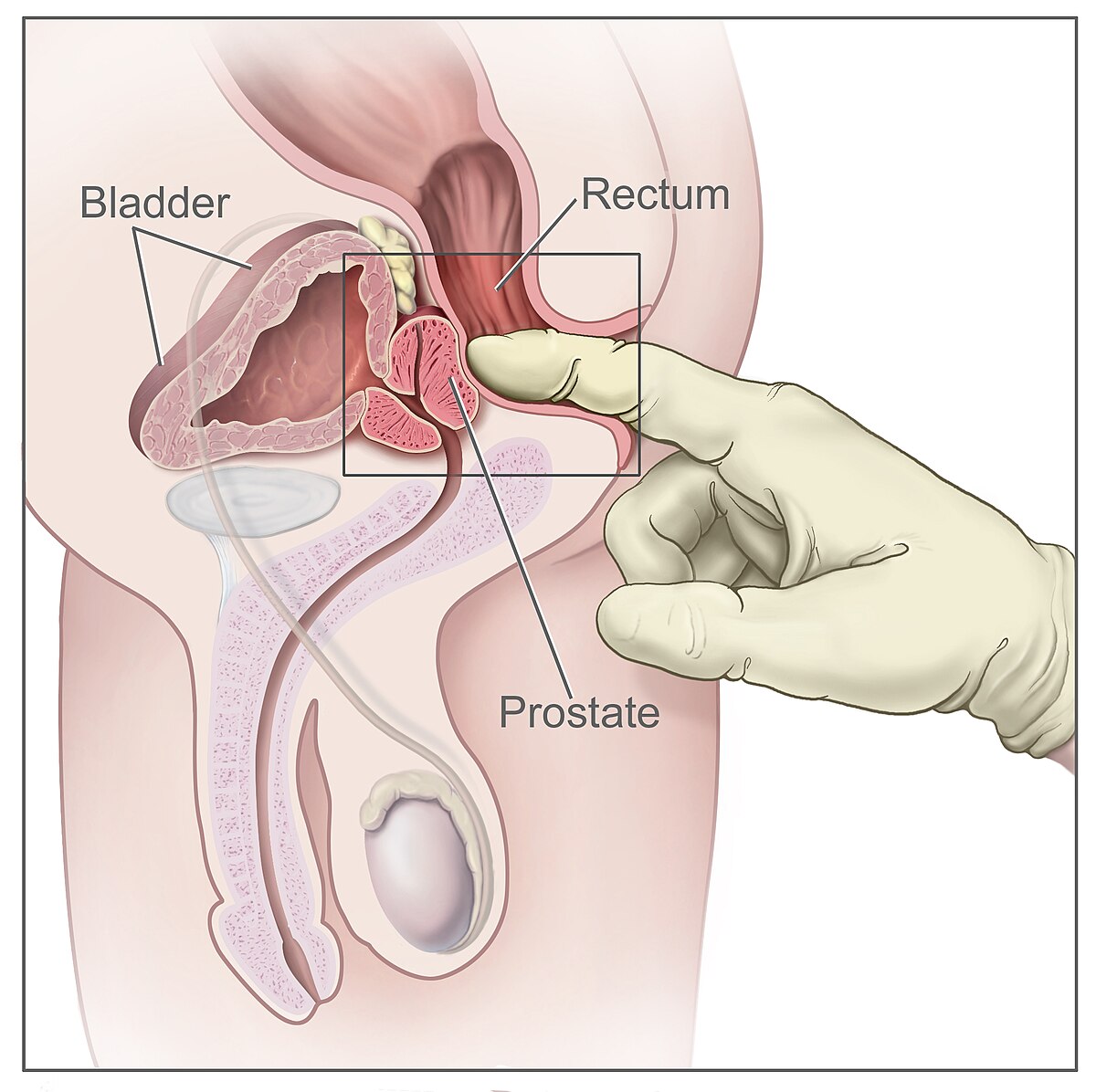 prostate milking story